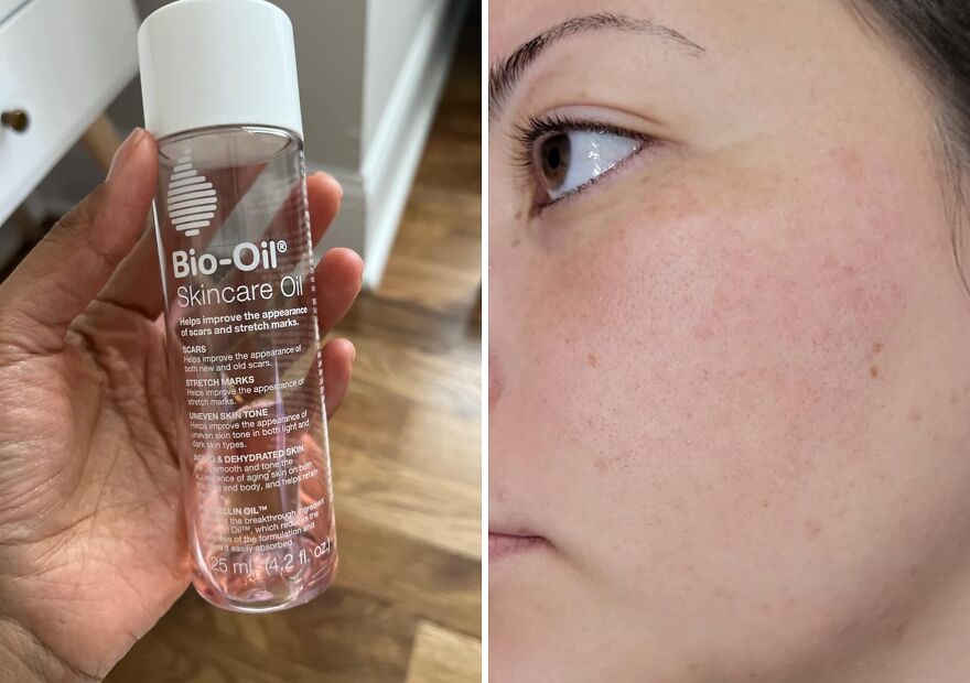 No Marks Left Behind: Bio-Oil Skincare - Your Go-To For Flawless Skin!