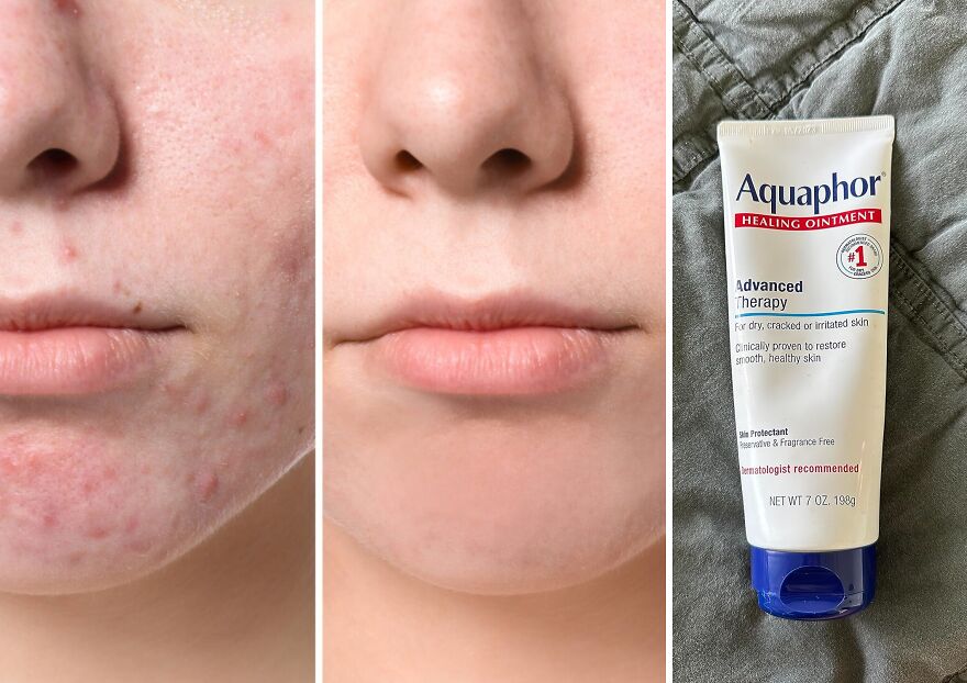 Aquaphor Healing Ointment : Your Ultimate Dry Skin Moisturizer For Unmatched Healing