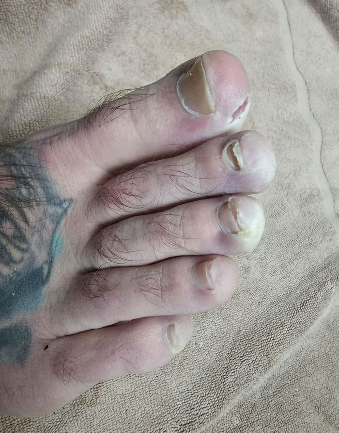 My Toes After Running A 50k