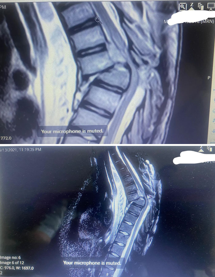 Radiografía tras romperme la espalda