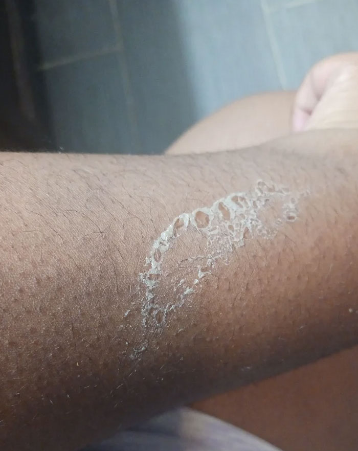 I Get Dandruff On My Arms And This Is How It Decided To Form Today