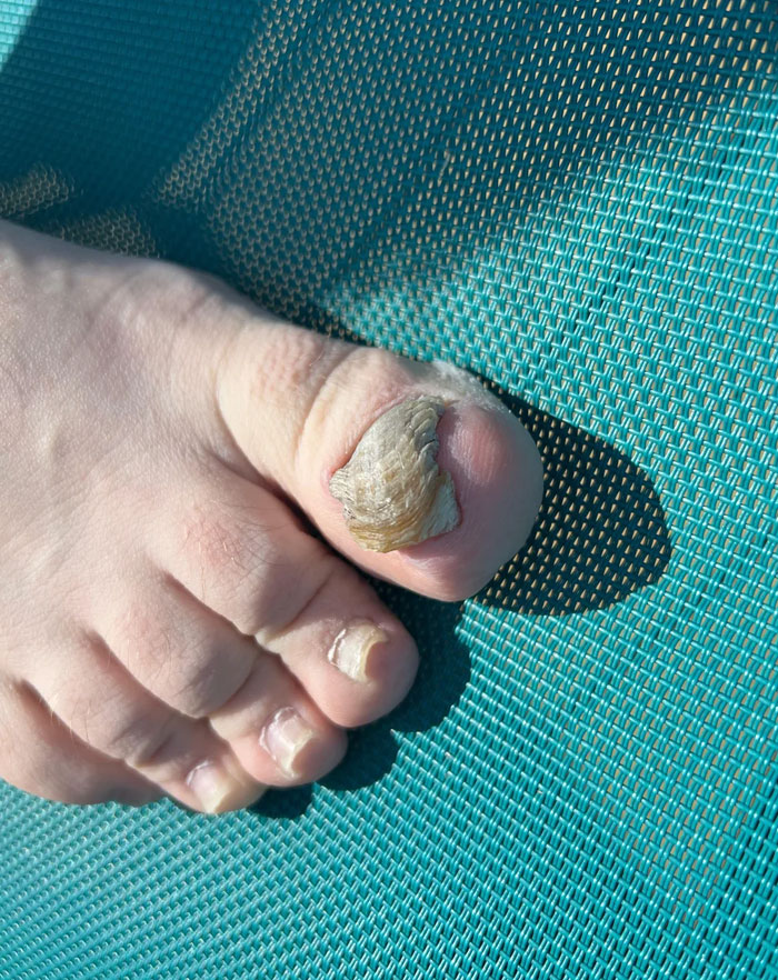 My Brother's Toe Nail He Refuses To Care For. Total Pork Rind