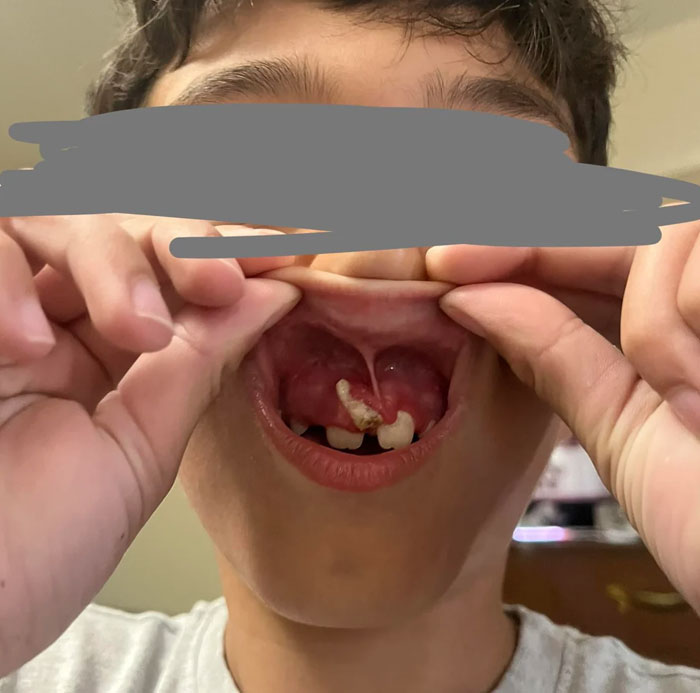 My Sons Baby Tooth Won’t Fall Out. Dentist Won’t Remove It