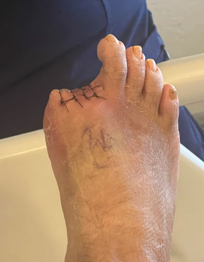 Got My Toe Amputated