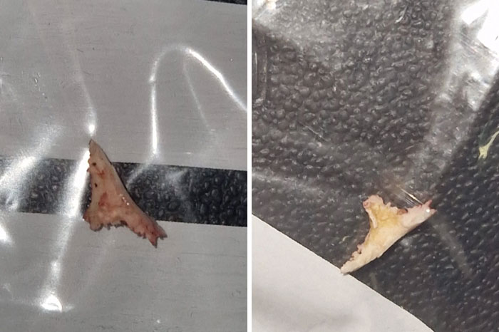 A Friend Had A Molar Removed. This Was Stuck In His Gum For Nearly 3 Weeks