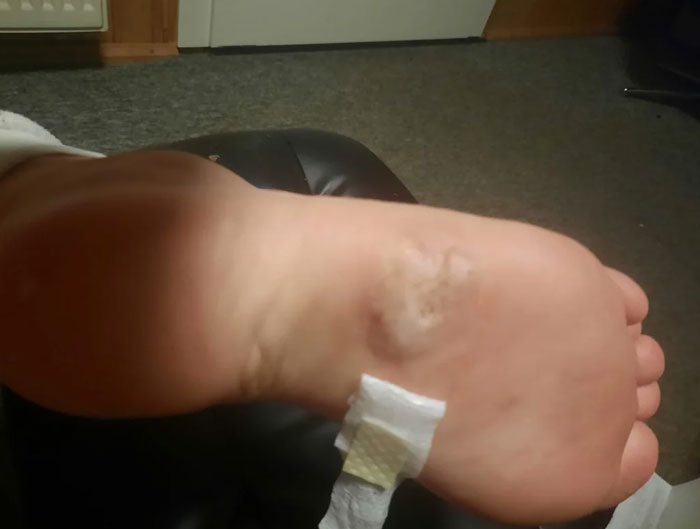 This Thing My Sister Has On Her Sole. No Doctor Could Tell Her What This Is And Where It Came From. Still Waiting For Diagnosis