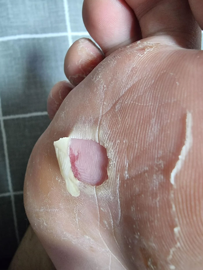Foot After 4 Days Of Military Training