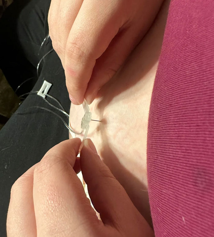 Needle Got Stuck In My Stomach, Nurse Said In All Her Years She Hasn’t Seen This Happen Before