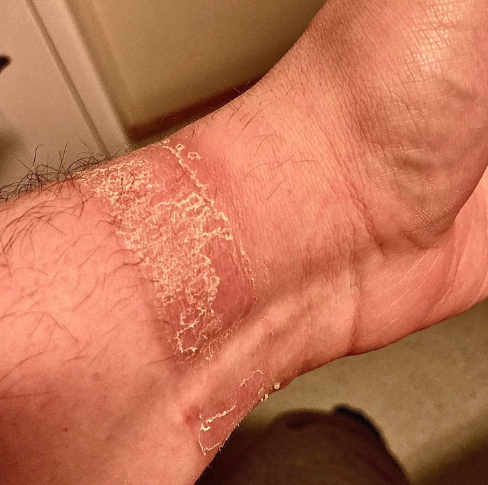 Let Me Introduce To You: My Wrist After Wearing Any Watch