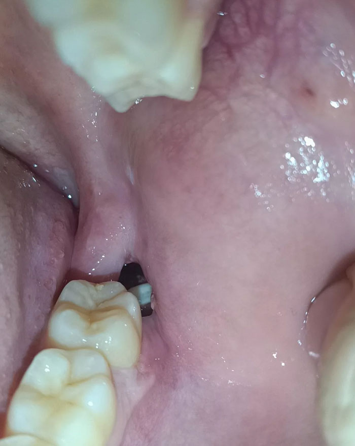 Grain Of Rice Lodged In My Fresh Wisdom Tooth Hole
