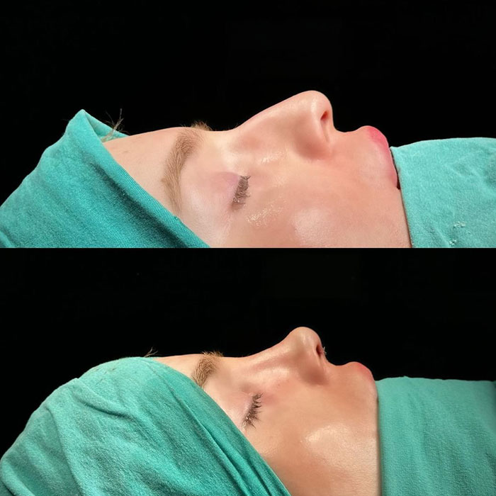 Activists Share Before And After Photos Of Their “Cheaper” Plastic Surgeries In Turkey Activists Share Before And After Photos Of Their “Cheaper” Plastic Surgeries In Turkey