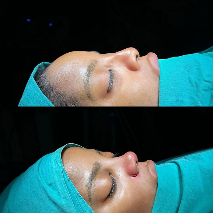 Activists Share Before And After Photos Of Their “Cheaper” Plastic Surgeries In Turkey
