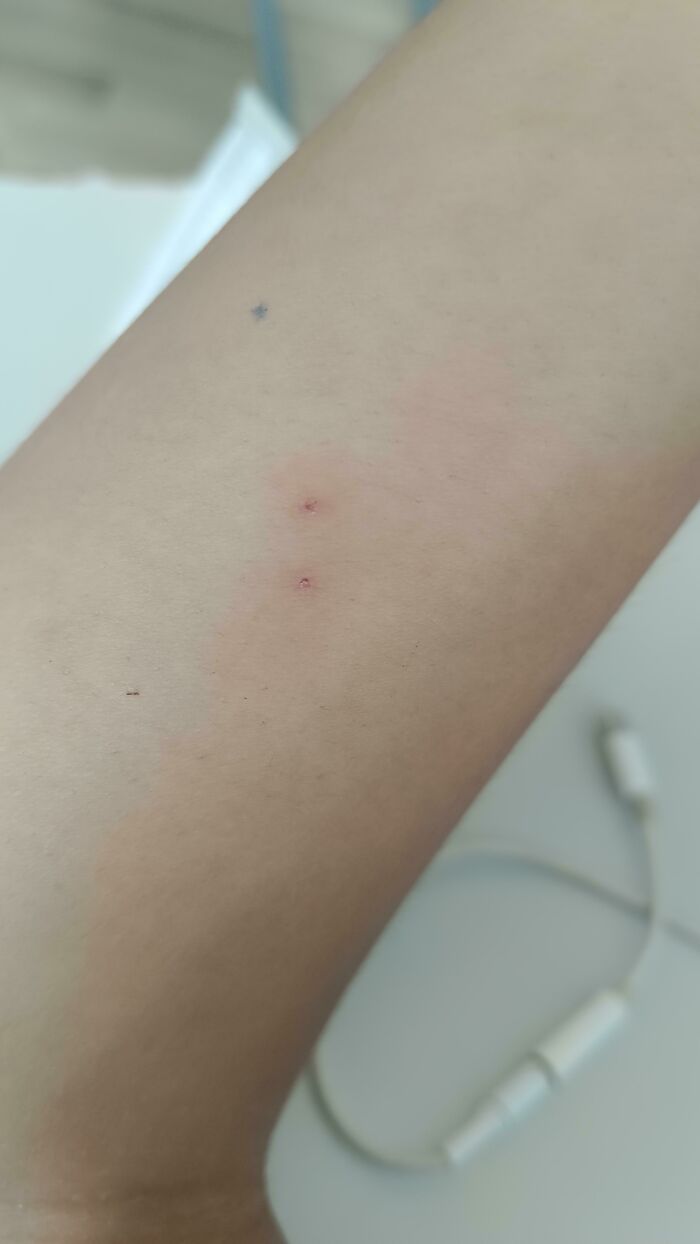 I Keep Getting These Wounds Which Are Always 2 Spots In This Pattern When I Wake Up, Usually Get It Down My Legs But Today I Got It On My Arm Now