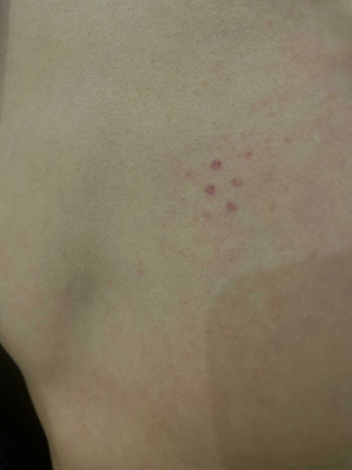 Very Few Mornings, I Wake Up With This Exact Hexagonal Pattern Of Bites/Marks In The Same Place On My Chest