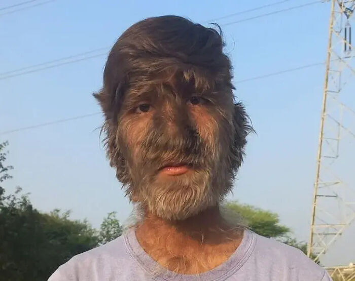A Teenager From Madhya Pradesh, India Has An Ultra Rare Condition Called 'Werewolf Syndrome' (Hypertrichosis). This Uncurable Condition Is So Rare That It Is Believed That Only 50 People Have Had It Since The Middle Ages