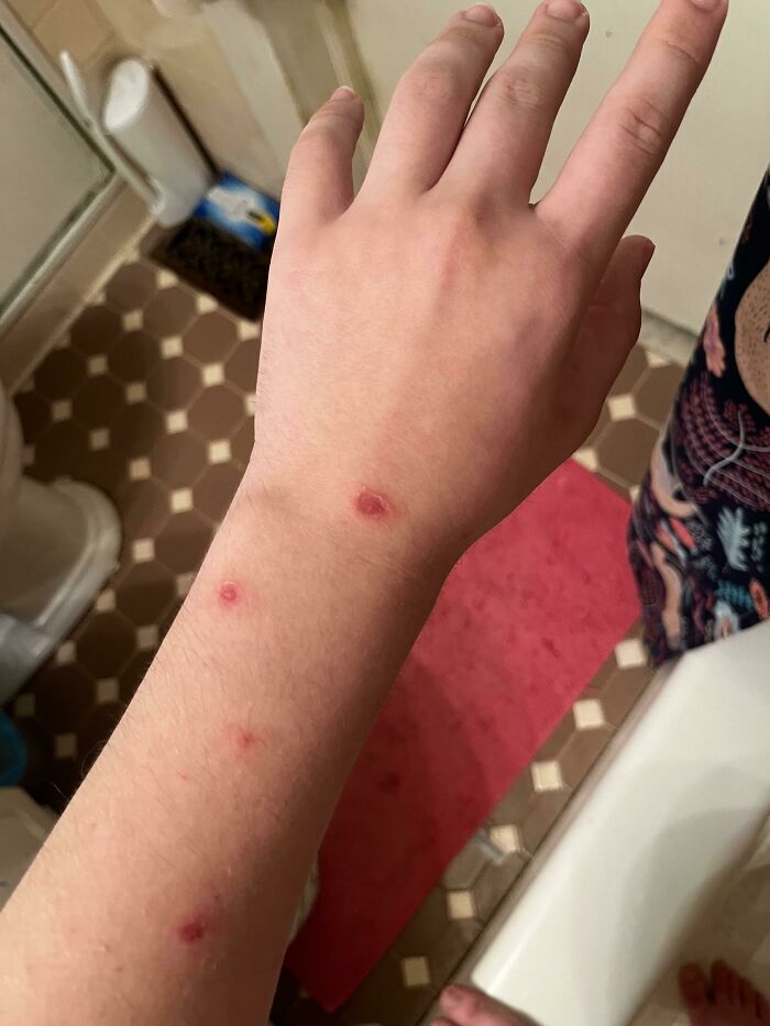 Weird Bumps That Have Appeared On My Arm, Maybe Bug Bites? Not Sure