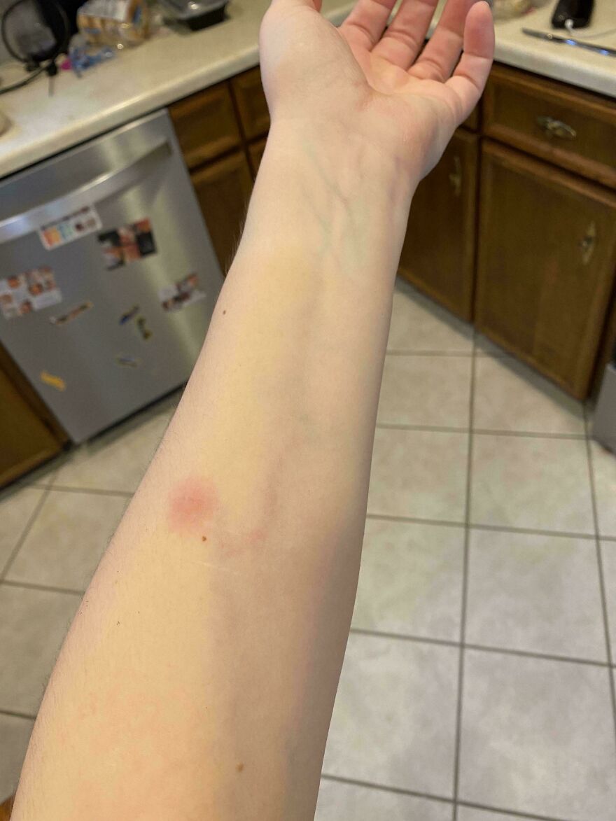 Woke Up With A Mystery Bite On My Arm And It’s Spreading Into My Bloodstream