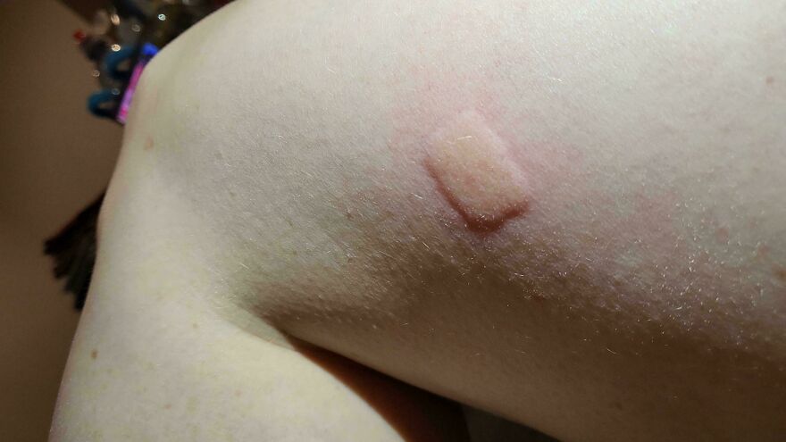 This Rectangular Reaction To A Mosquito Bite On My Leg