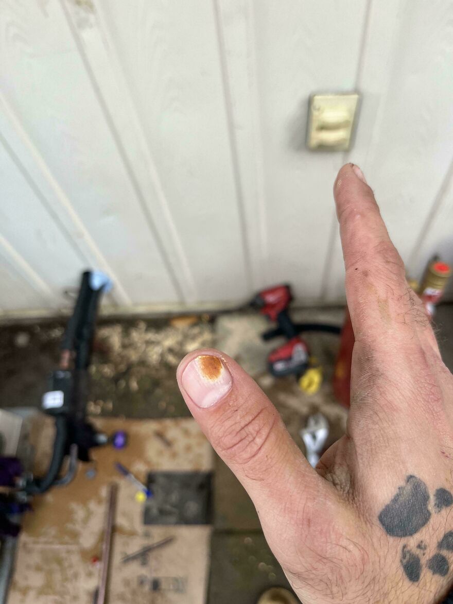 Less Than One Second Of 3,000°f Flame To A Finger Nail