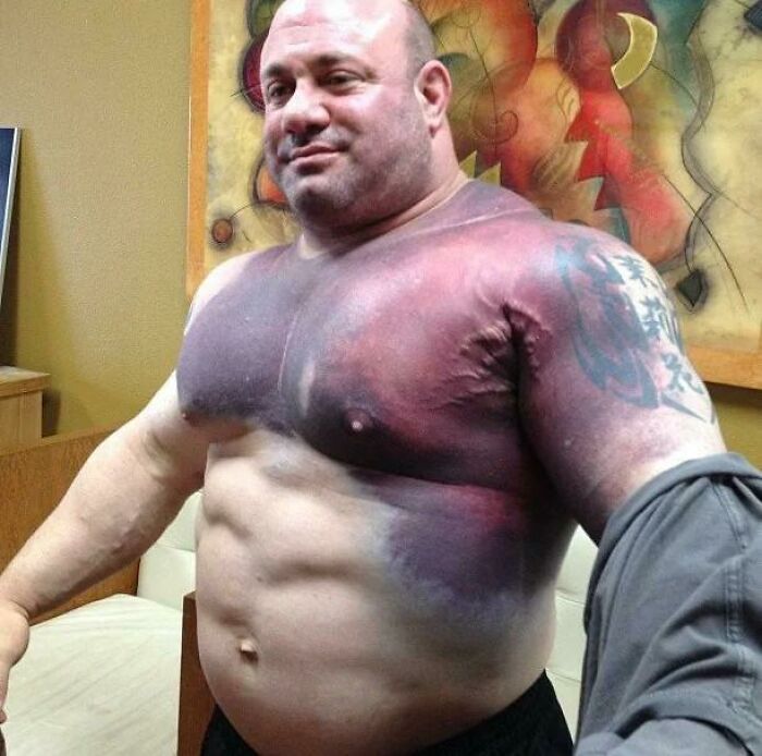 The Bruise On Scott Mendelson—and Scott Mendelson Himself—after Tearing His Pec Muscle While Attempting A Bench Press World Record