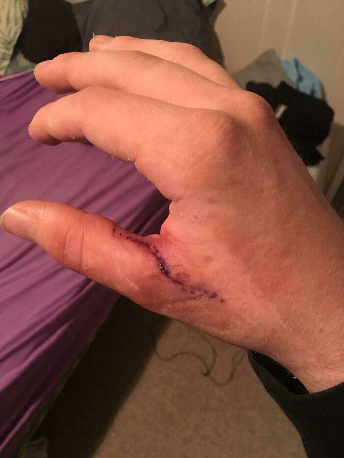 My Thumb Out Of Plaster Cast After Surgery To Reattach Tendon