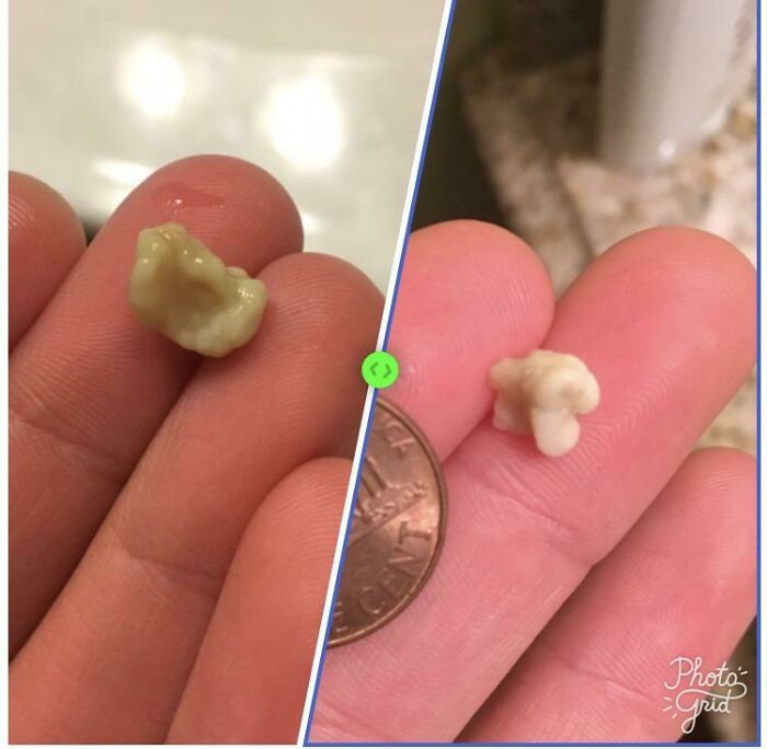 Some Of My Biggest Tonsil Stones