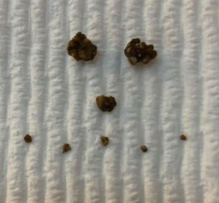 My Friend Made A Face Out Of Her Kidney Stones