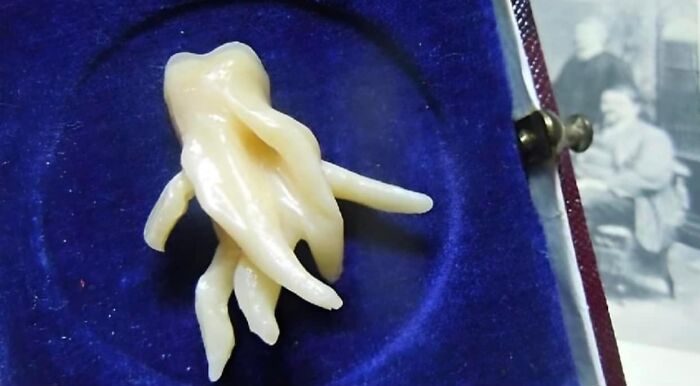 This Wisdom Tooth's Root