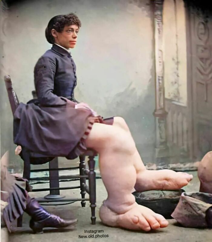 When Fanny Mills Emigrated From England To Sandusky, Ohio In The 1860s, She Was A Petite Teenager Of Only 115 Pounds — But She Carried Most Of That Weight In Her Legs And Feet