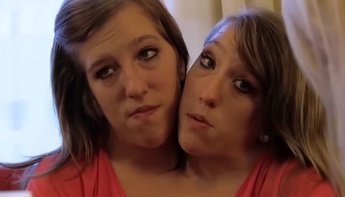 Dicephalus-Conjoined Twin Abby Hensel Of “Abby & Brittany” Is Married