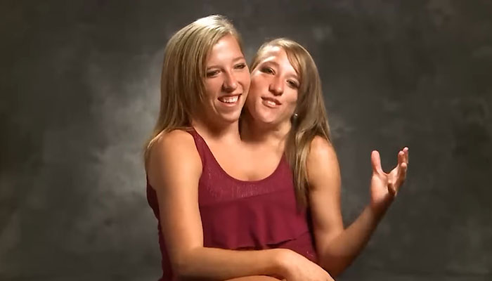 Dicephalus-Conjoined Twin Abby Hensel Of “Abby & Brittany” Is Married Dicephalus-Conjoined Twin Abby Hensel Of “Abby & Brittany” Is Married