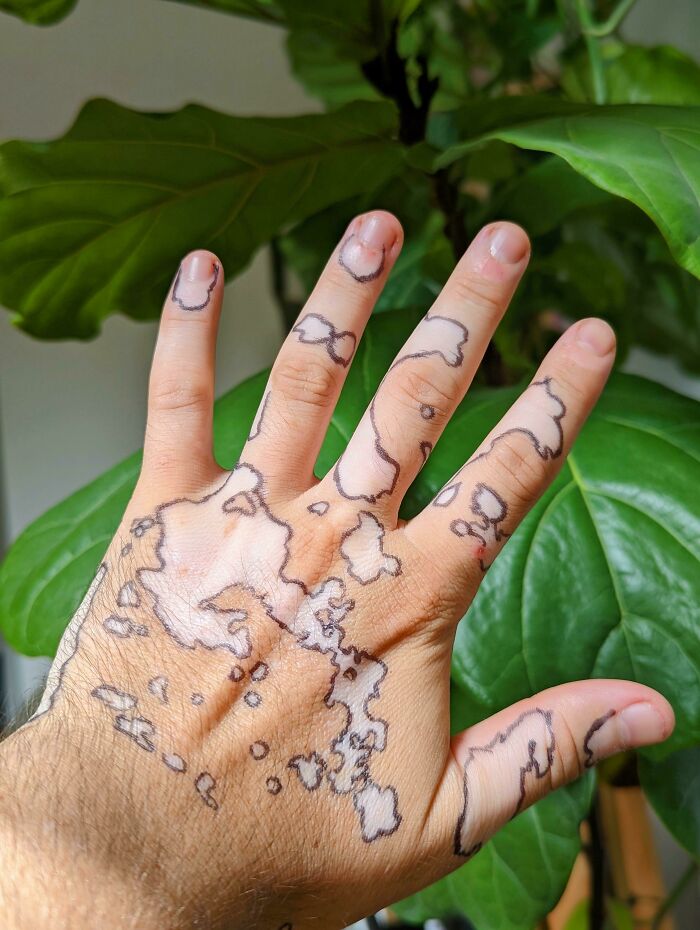He pintado alrededor de mis marcas de vitiligo