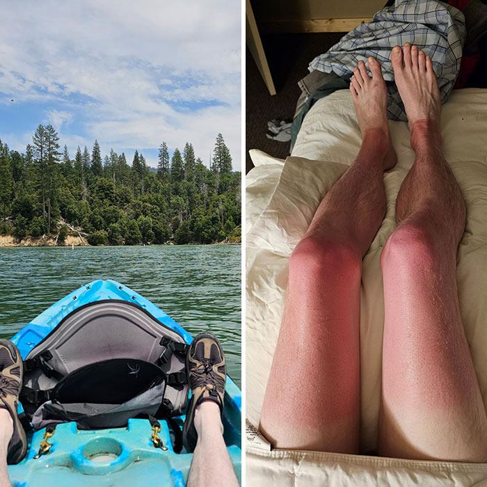 Se me olvidó ponerme protector solar en las piernas durante el viaje en kayak por el lago