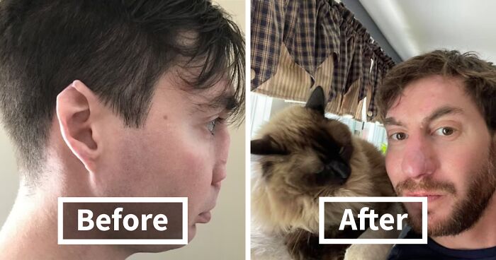 Before And After Of Man Who Received “Amazing” Nasal Reconstruction After Getting Mauled By Dog
