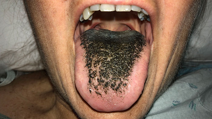 “Black Hairy Tongue” A Condition Caused By Antibiotics