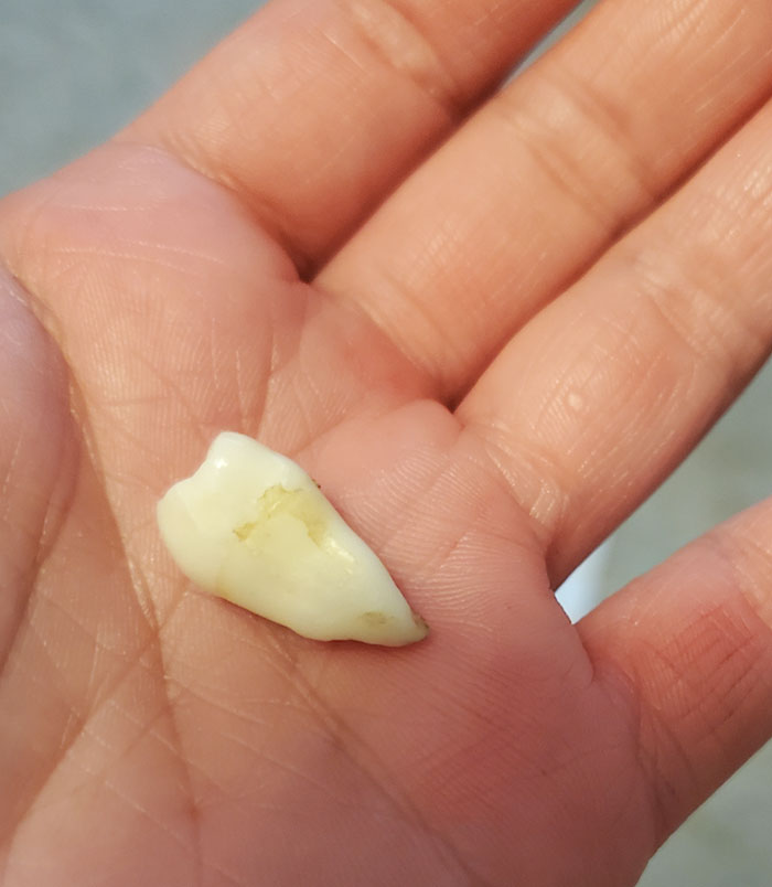 My Tooth Has A Big Single Root Instead Of 4 Small Ones