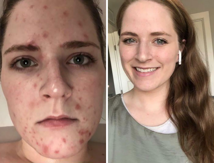 A Lot Has Changed In My Life Over This Past Year. I Didn’t Realize How Much Sobriety Helped My Skin Until Looking Back At Old Photos. February, 2020 vs. Today