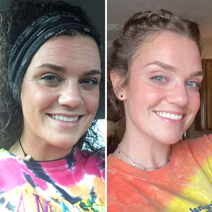 26 To 30. I Am A Recovered Alcoholic, Quit Smoking A Pack A Day, Developed A Skincare Routine That Makes Me Glow, And Blasted My Forehead With Botox