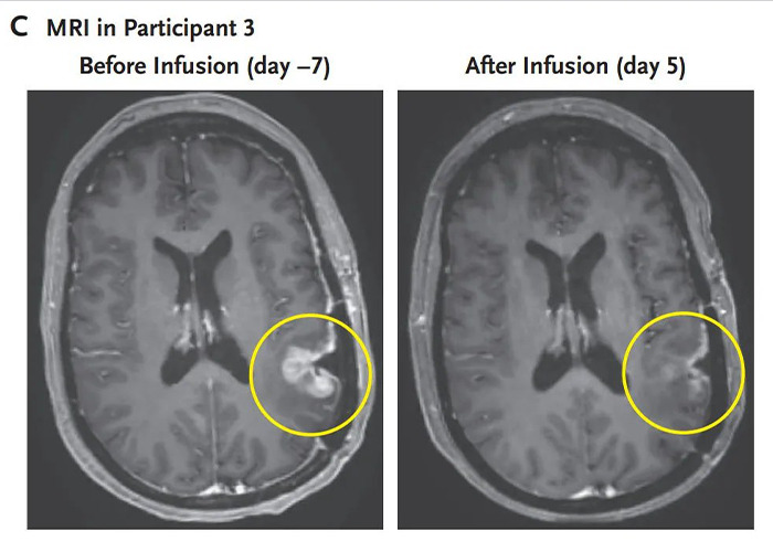 New Cancer Treatment Sees Brain Tumor Shrink In Five Days