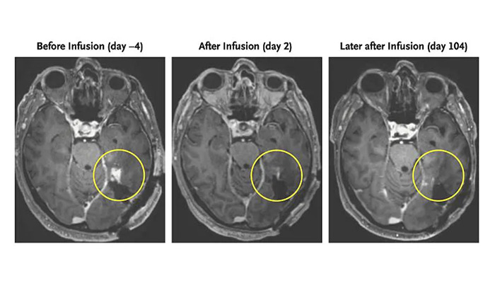 New Cancer Treatment Sees Brain Tumor Shrink In Five Days