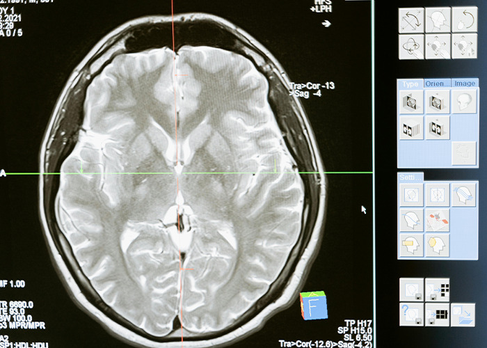 New Cancer Treatment Sees Brain Tumor Shrink In Five Days