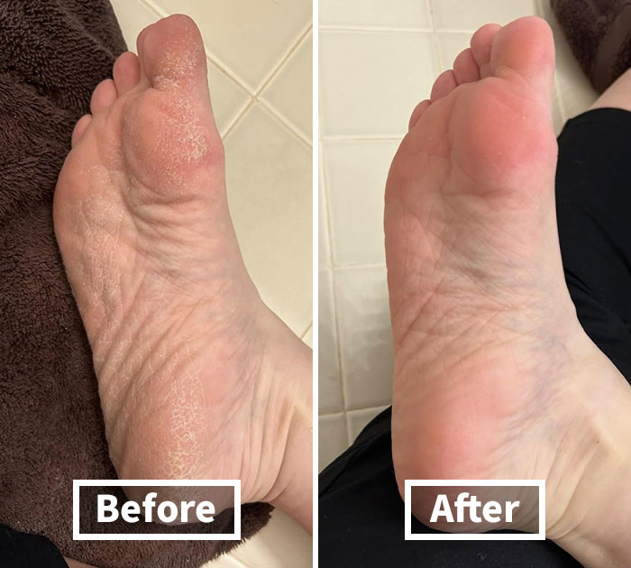 Barefoot Bliss Awaits With Lee Beauty's Pro Callus Remover For Feet