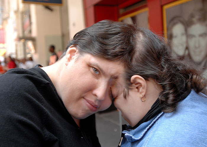 “Why Fix What Isn’t Broken?”: World’s Oldest Conjoined Twins Pass Away Aged 62 “Why Fix What Isn’t Broken?”: World’s Oldest Conjoined Twins Pass Away Aged 62