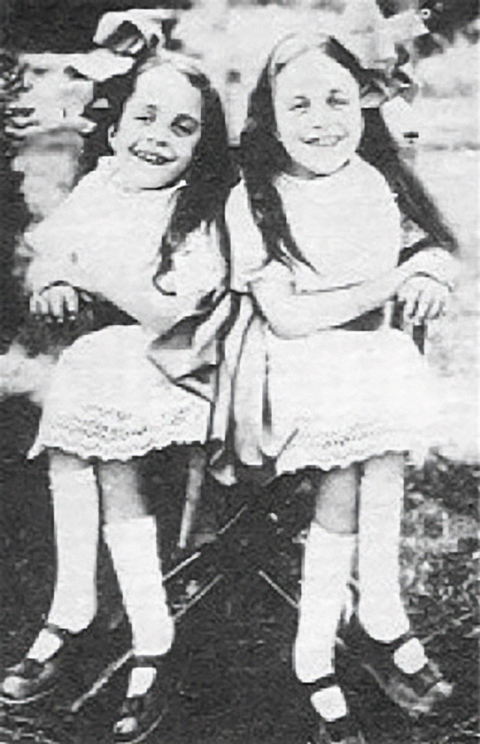 People Learn Harrowing Story Of Conjoined Twins, Which Ended With One Alive And The Other Not People Learn Harrowing Story Of Conjoined Twins, Which Ended With One Alive And The Other Not