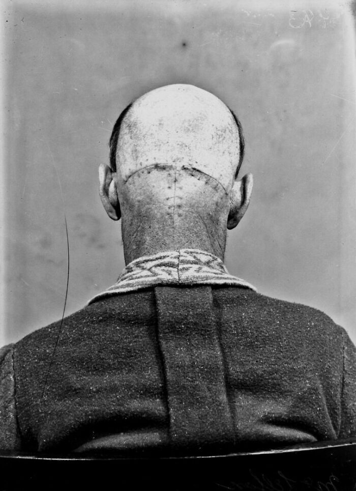 Surgery Patients Of Dr. Harvey Cushing