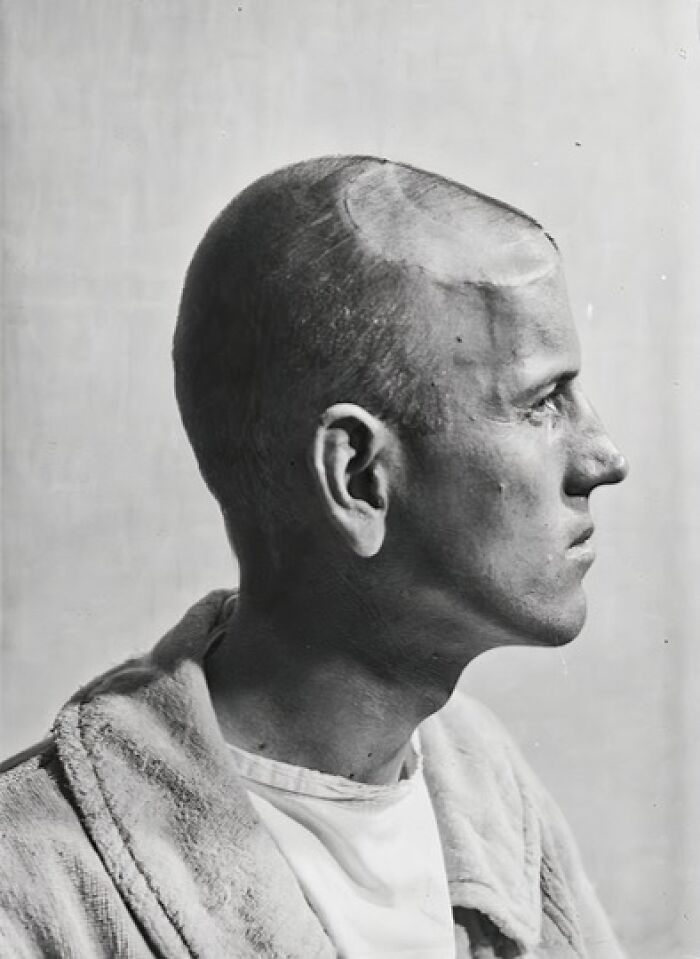 Surgery Patients Of Dr. Harvey Cushing