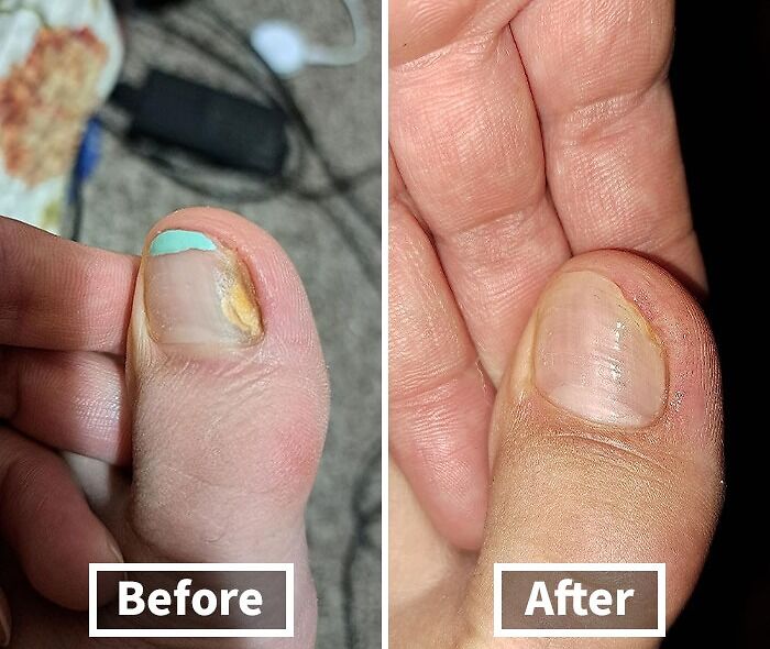 Revive Your Nails: Kerasal Leads The Way In Fungal Nail Renewal