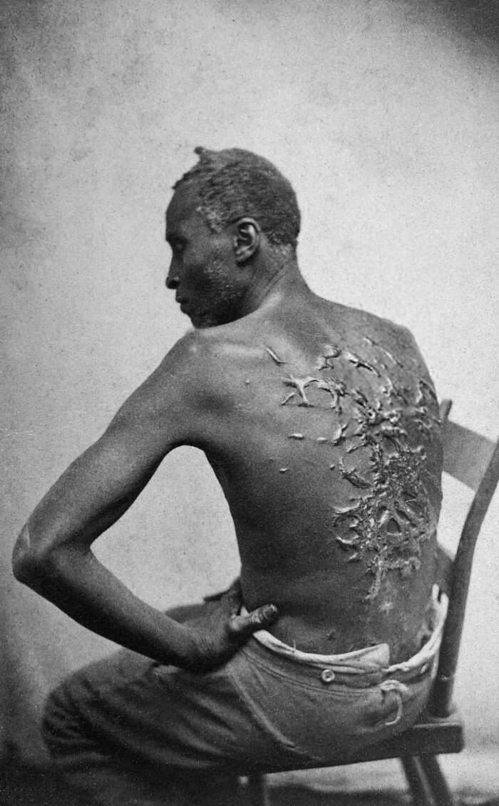 Gordon, ex-esclavo, mostrando sus cicatrices causadas por los látigos. Luisiana, 1863