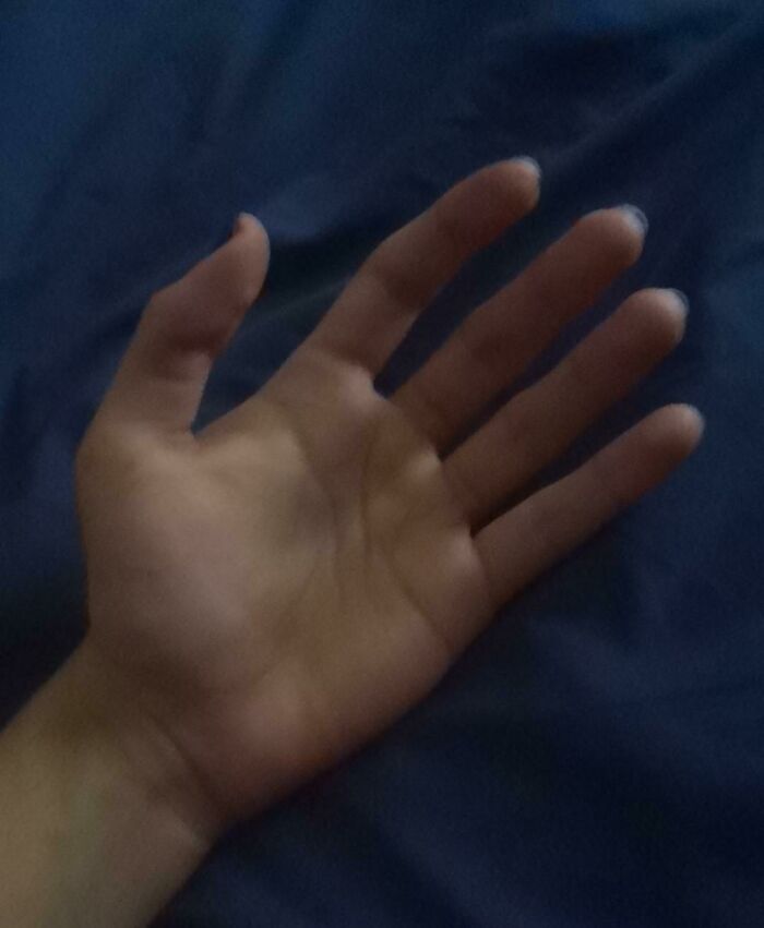 Due To A Genetic Normality I Was Born With Exactly 5 Fingers