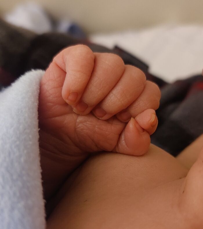 My Son Was Born With An Extra Thumb